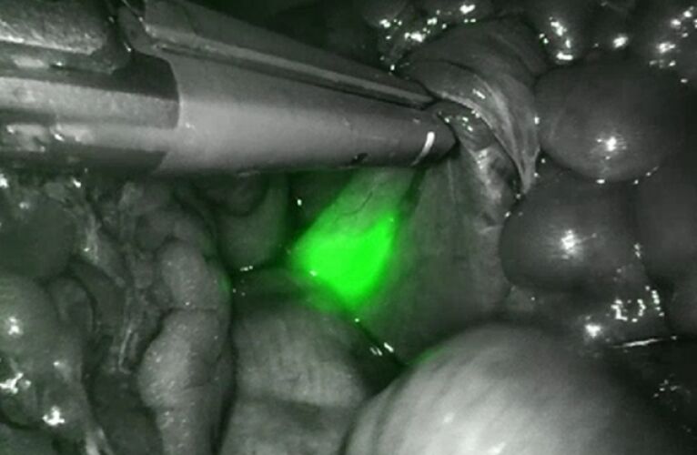 Darmkanker: op weg naar minder ingrijpende behandelingen